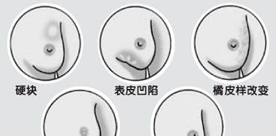 乳腺癌的早期症状和前兆（乳腺癌有5类高危人群）-第3张图片