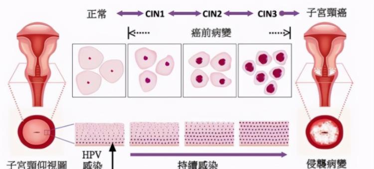 医生朋友建议不打宫颈癌疫苗（宫颈癌疫苗到底有没有必要打）-第2张图片