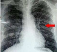 正宗的夫妻肺片里有肺片吗（教你看肺部ct片子）-第1张图片