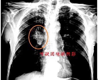 正宗的夫妻肺片里有肺片吗（教你看肺部ct片子）-第6张图片
