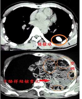 正宗的夫妻肺片里有肺片吗（教你看肺部ct片子）-第5张图片