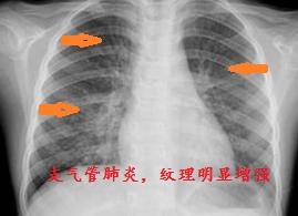 正宗的夫妻肺片里有肺片吗（教你看肺部ct片子）-第3张图片