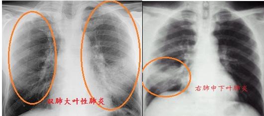 正宗的夫妻肺片里有肺片吗（教你看肺部ct片子）-第2张图片